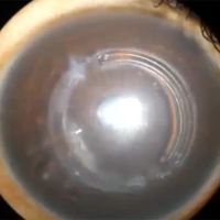 Segmentos intraestromales alogénicos corneales (CAIRS) y CLCXL