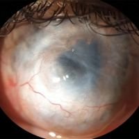 Escleroqueratoplastia