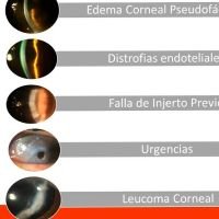 Queratoplastias en Hospital Italiano de Bs. As.