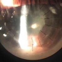 ¿Hongos o herpes en mi PKP?