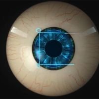 Sutura de Retención en DSEAK