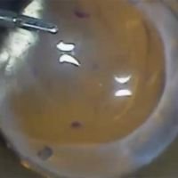 Descemet Stripping Only