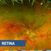 Oclusiones venosas de la retina: clínica y tratamiento