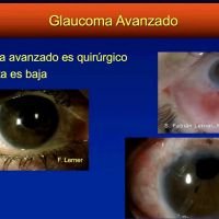 Glaucoma avanzado