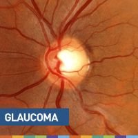 Glaucomateando (Parte 1)