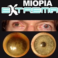 Miopía Extrema