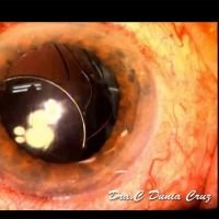Corrección de una lente intraocular plegable descentrada OD
