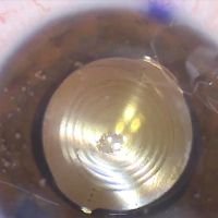 LIO multifocal torico en catarata bilateral congenita