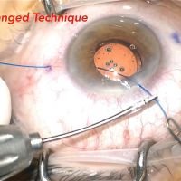 Piercing Flanged Technique for all Single Piece IOL Fixation