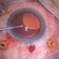 Un abordaje distinto a la extracción de lente intraocular
