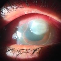 DALK en leucoma vascularizado