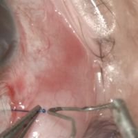 Prelone y Cirugia de Glaucoma