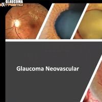 ¿Cuándo debo pensar que va a tener glaucoma neovascular?