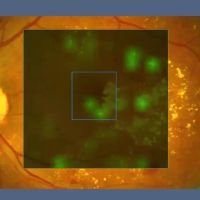 Inteligencia artificial en Glaucoma