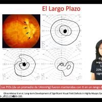 Miopía Extrema & Discapacidad visual: Glaucoma