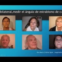 Miopía Extrema & Discapacidad visual: Estrabismo
