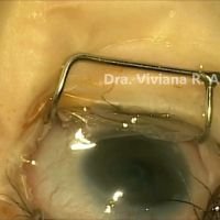Cirugia en Glaucoma Infantil