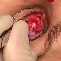 Dermis Fat Grafting for Socket Reconstruction a customized approach