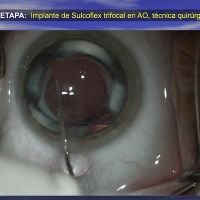 Presbicia Pseudofaquica y astigmatismo