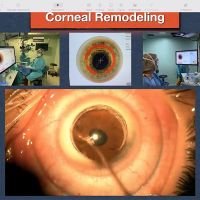 Corneal Remodeling