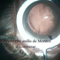 Faco en cornea con queratotomía radiada