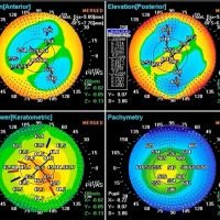Cirugía refractiva en ectasias corneales