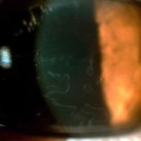 Catarata y Distrofia de membrana basa