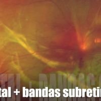 Drr Total + Bandas Subretinales