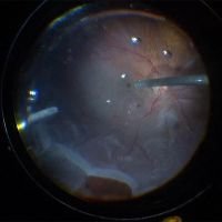 Manejo de desgarro retinal gigante