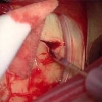 Tratamiento de las hemorragias subretinianas y supracoroideas masivas. Un nuevo enfoque quirúrgico