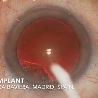 Cirugía Dr. Bilbao con IOL Isopure de BVI